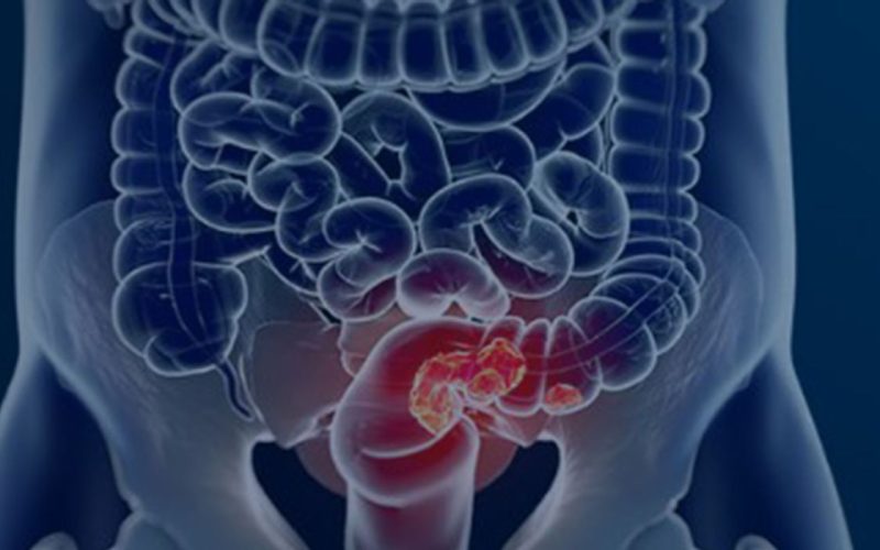 SUS implementa exame inovador para detecção de câncer colorretal entre os cidadãos